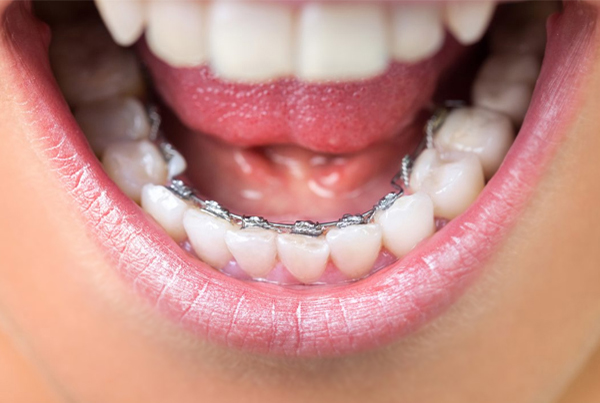 Lingual Braces