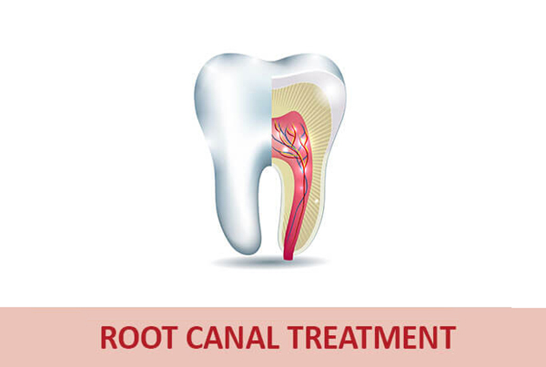 Root Canal Treatment