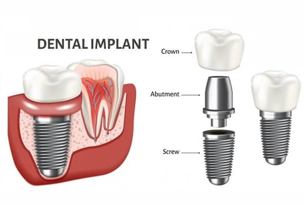 Dental Implant