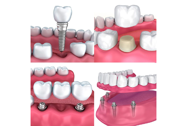 Implant Supported Single and Full Mouth Rehabilitation