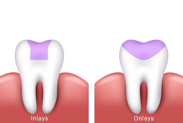 Inlays,Onlays and Crowns