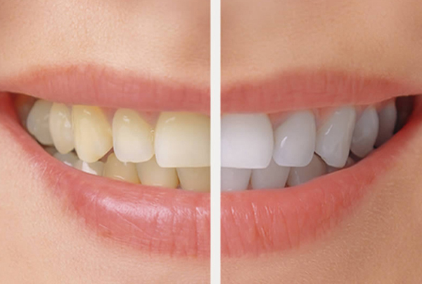 Teeth Bleaching