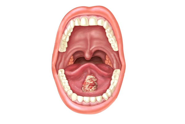 Tobacco Related Lesions