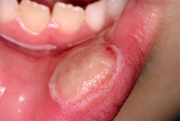 Infectious Diseases and Oral Ulcerations