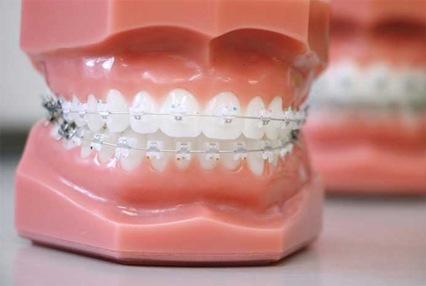 Tooth Color Braces