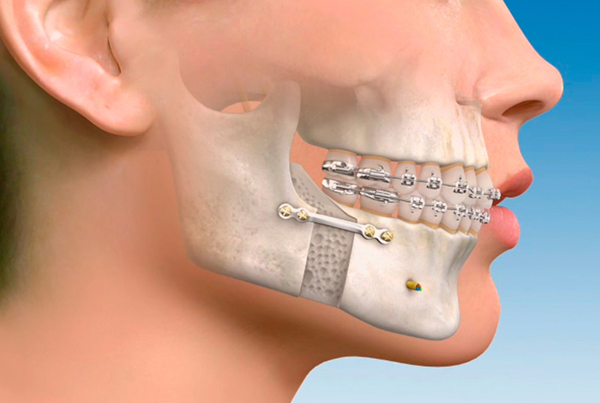 Jaw Surgery