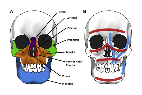 Facial Trauma