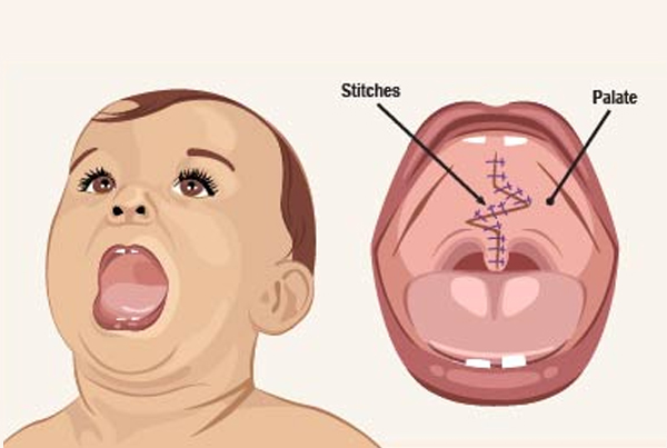 Cleft Lip and Palate