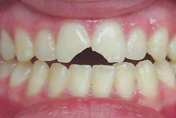 Trauma to Anterior Teeth