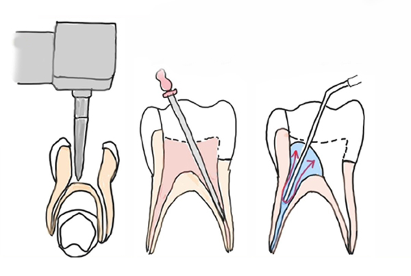 Pulpectomy